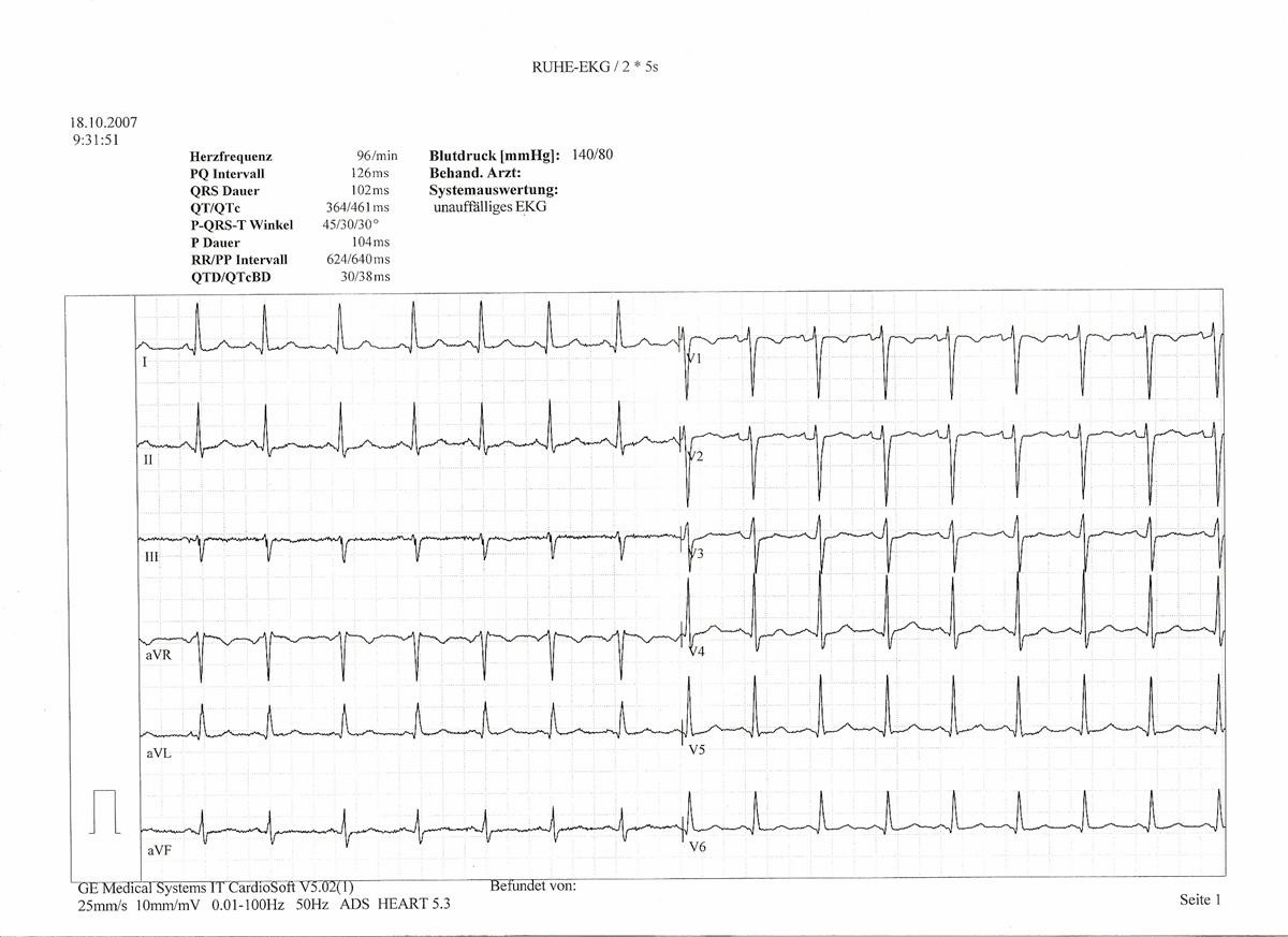 A printed twelve-lead electrocardiogram on a grid, with heart rate and intervals listed at the top